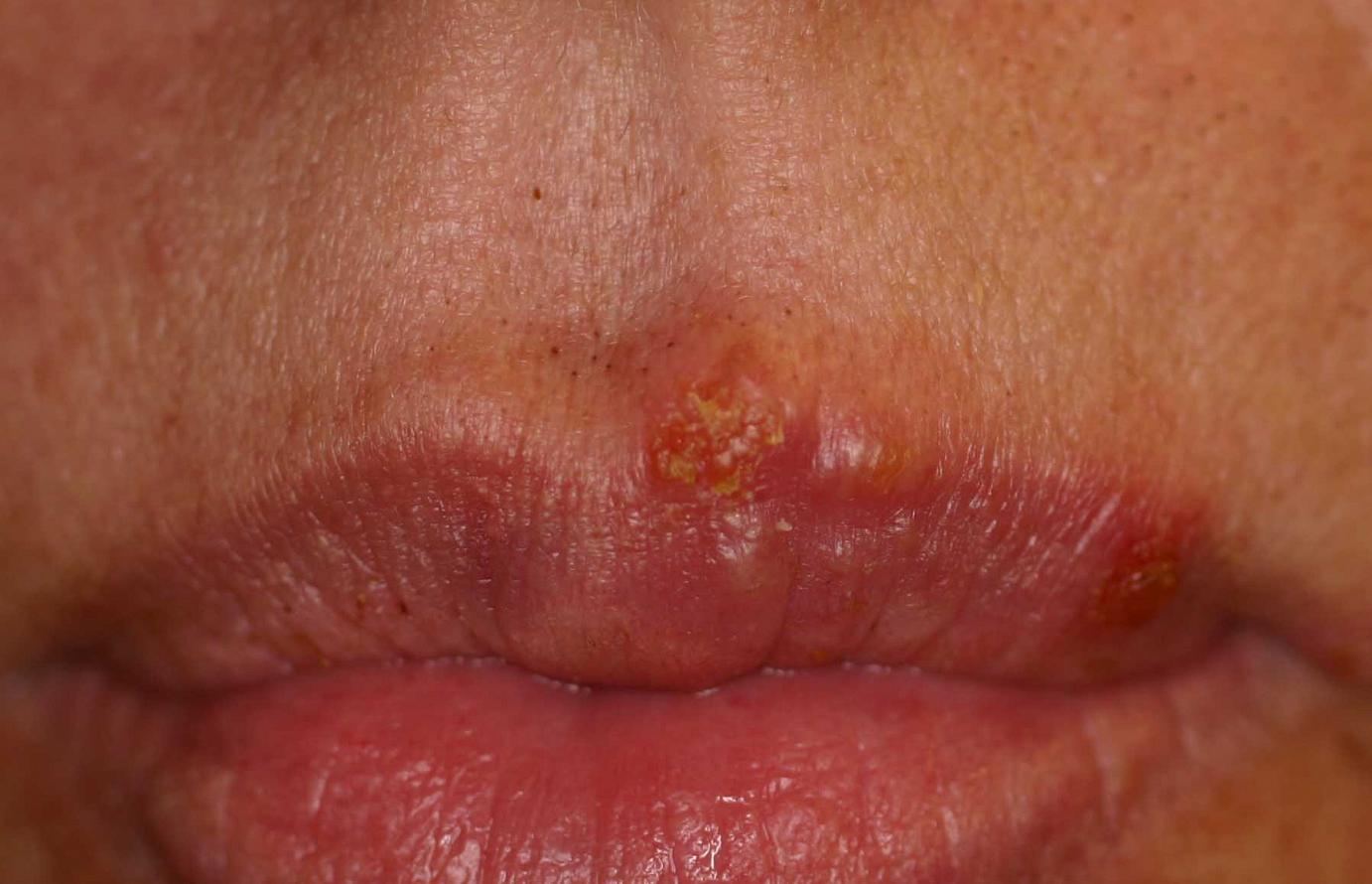 genital acne picture