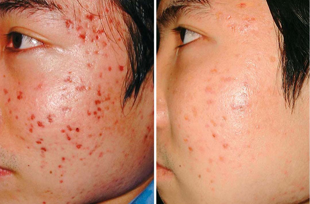 Acne After Pregnancy
