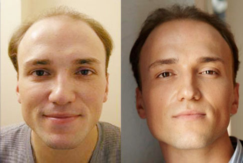Hair Restoration With Dr. Milchak