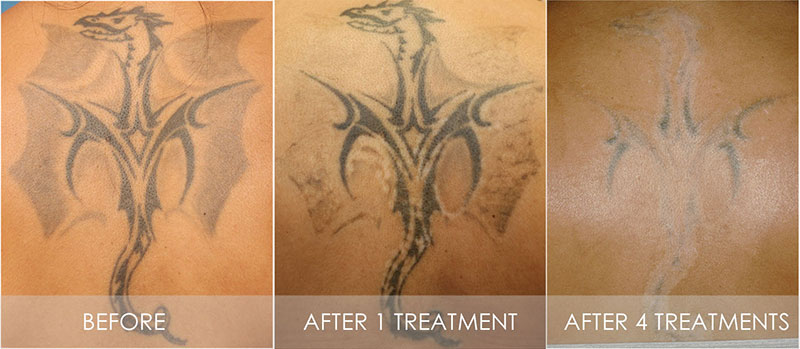 Tattoo removal before and after