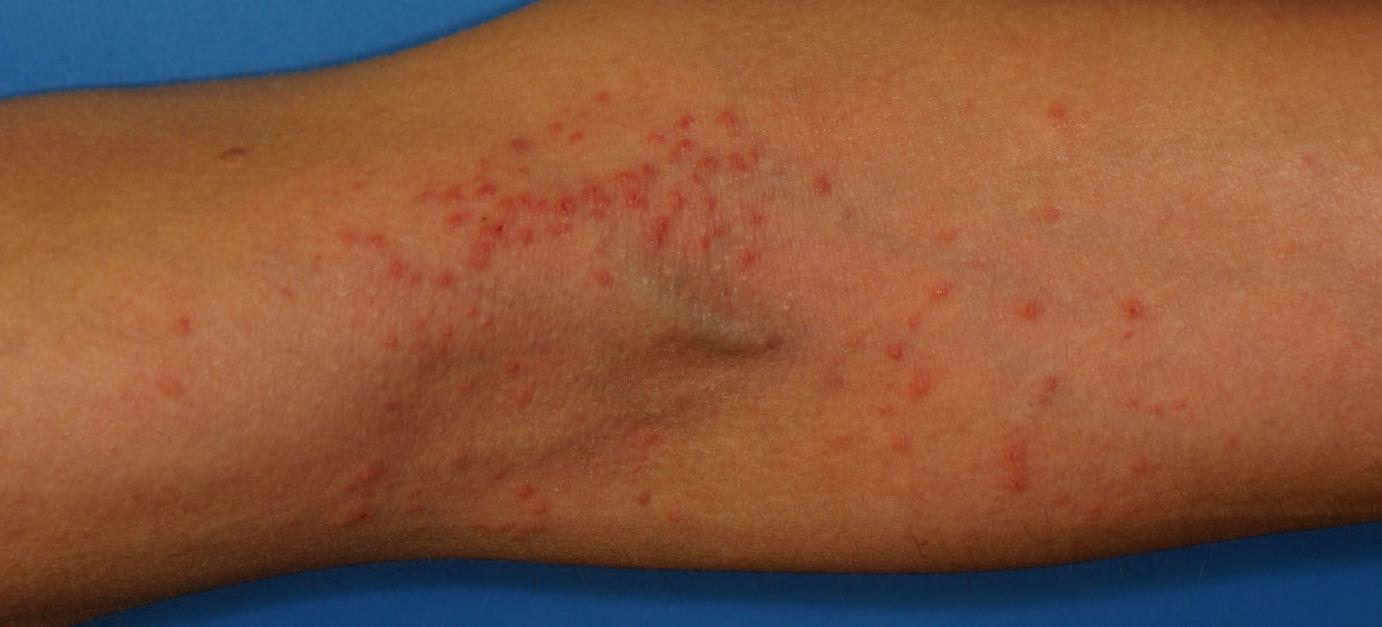 atopic dermatitis treatment