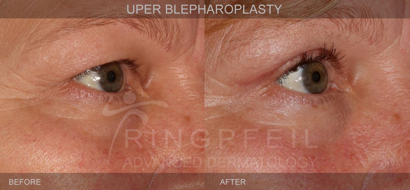 Upper Blepharoplasty Procedure