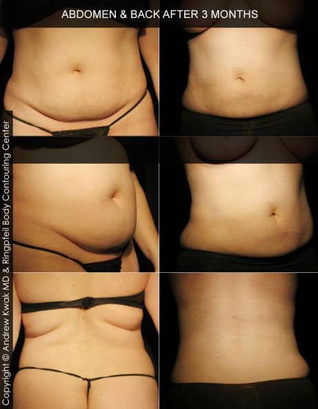 photos abdomen before and after 3 months Liposuction procedure