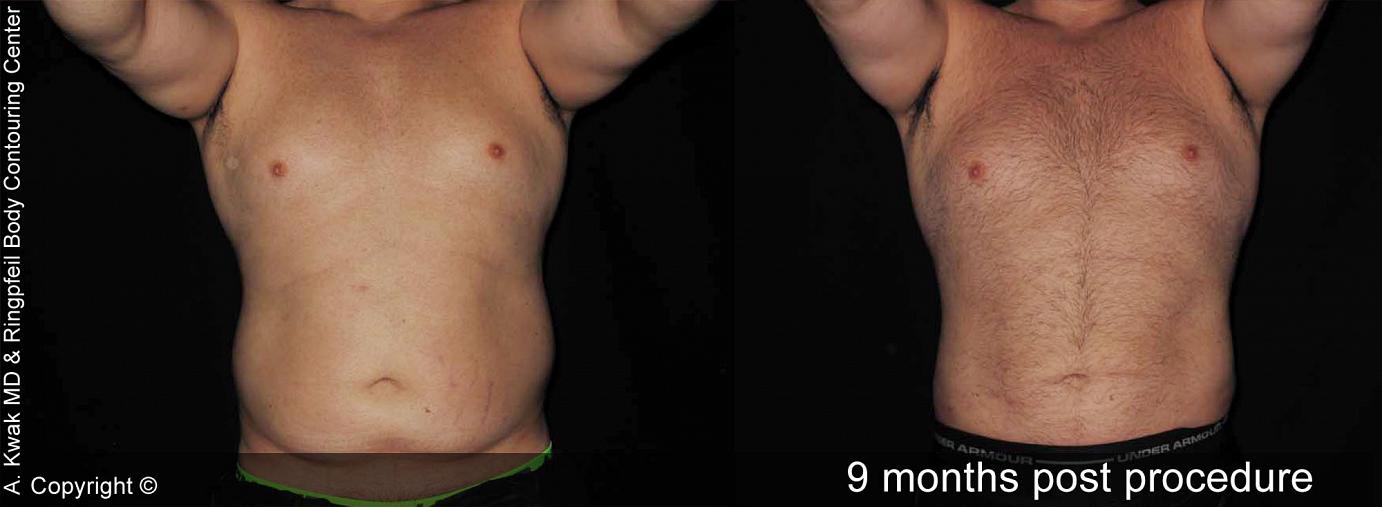photos patient Before And After 9 Months Abdomen Liposuction