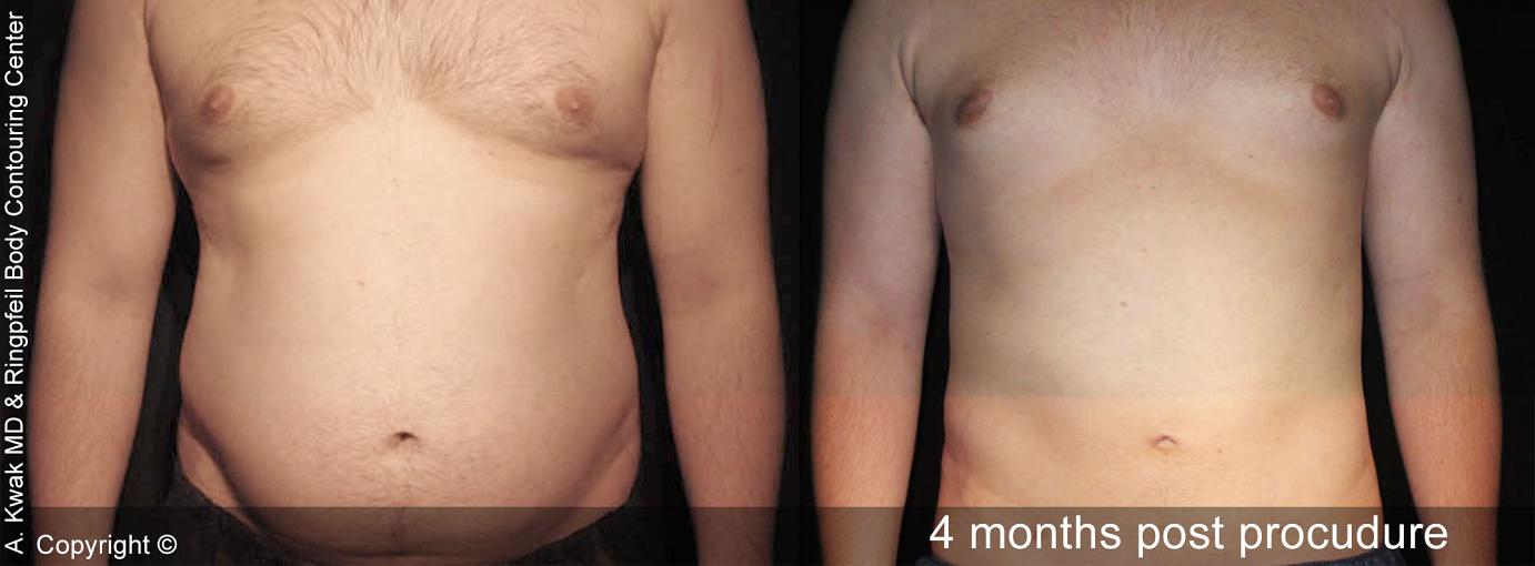 photos patient Before And After Smart Lipo - 4 months post procedure