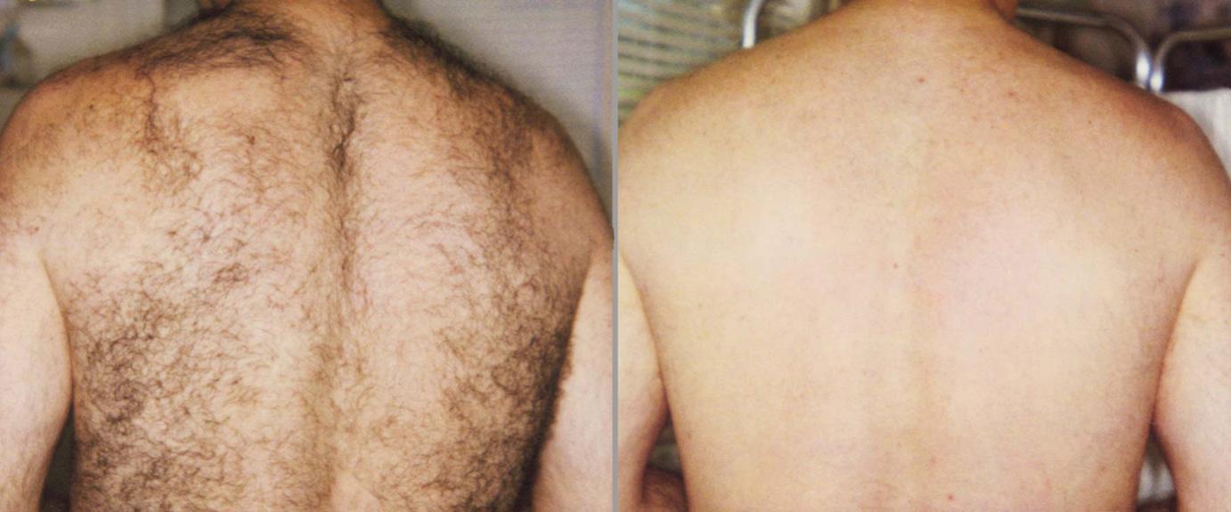 Lasering men back hair in Philadelphia