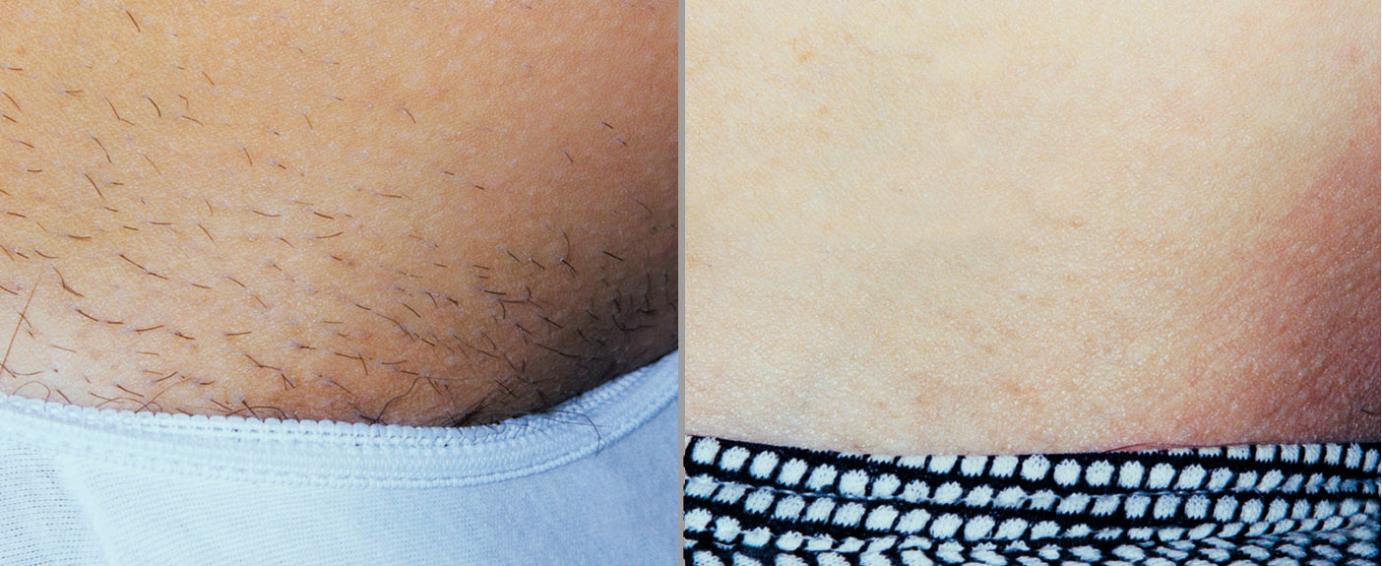 arms, legs, Underarms, and hands laser hair removal for men and women ...