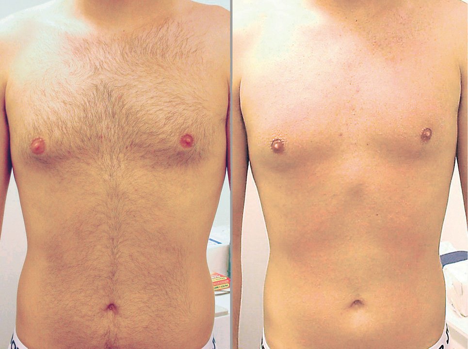 Male Wax Hair Removal Phoenix | Male Models Picture