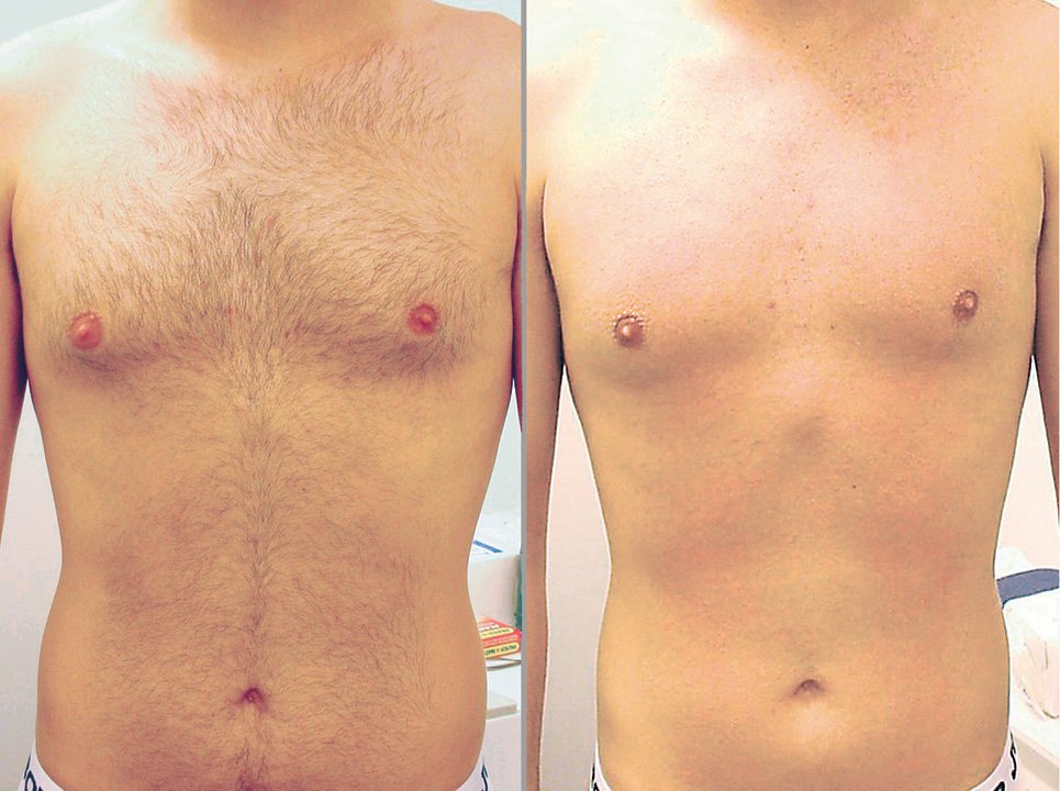 removing men body hair with laser in Philadelphia