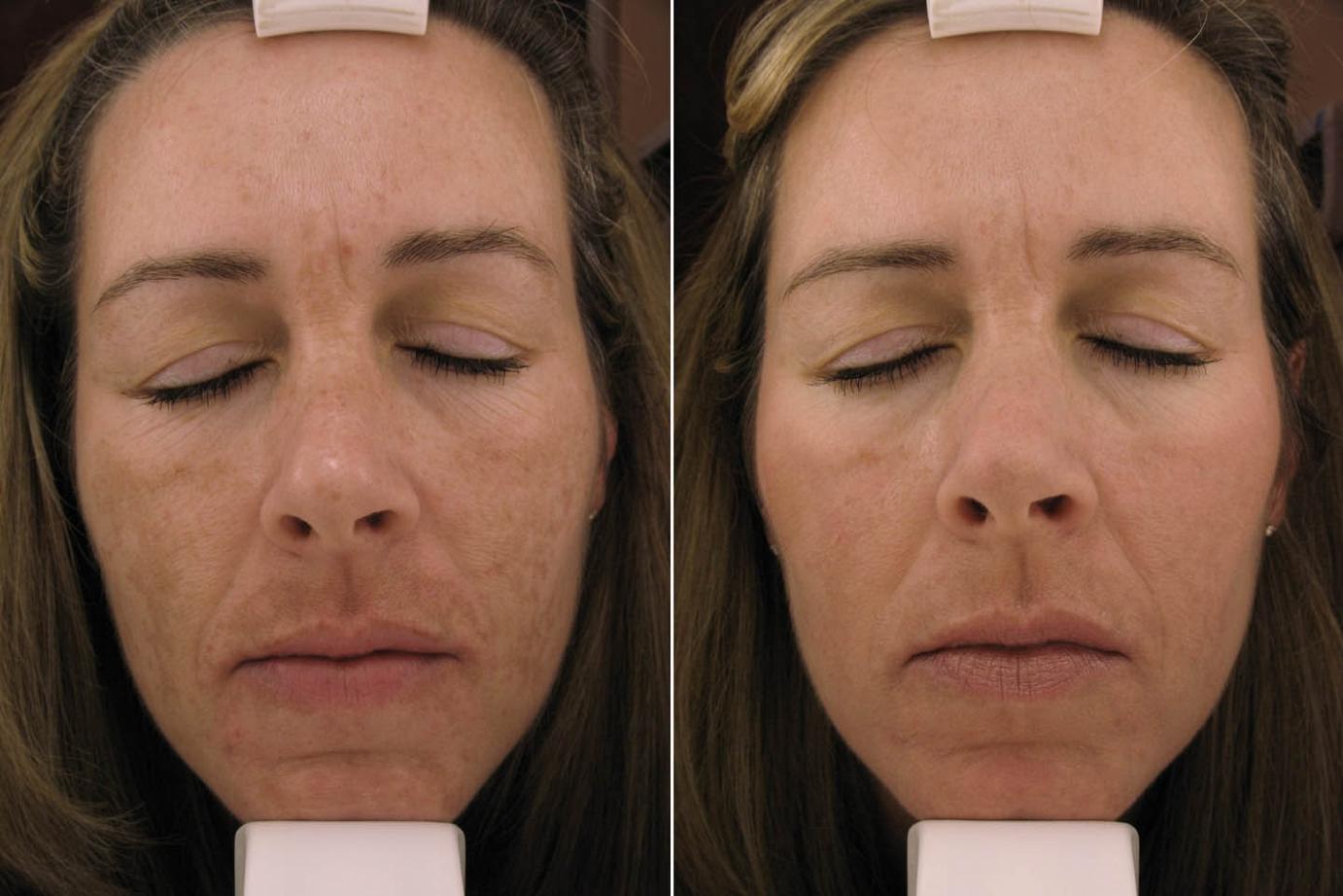 Front Before & After Melasma Treatment