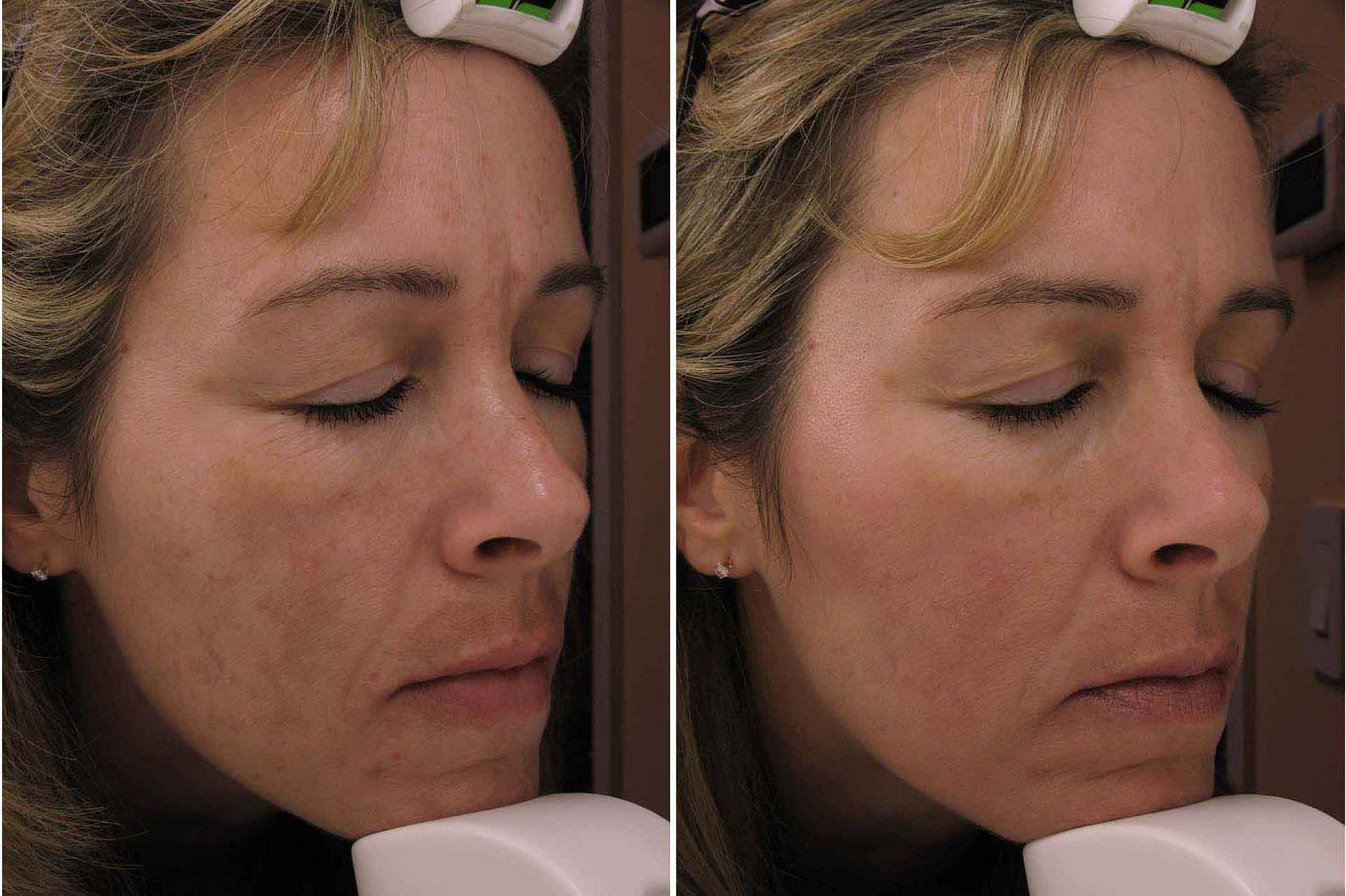 Right Before & After Melasma Treatment