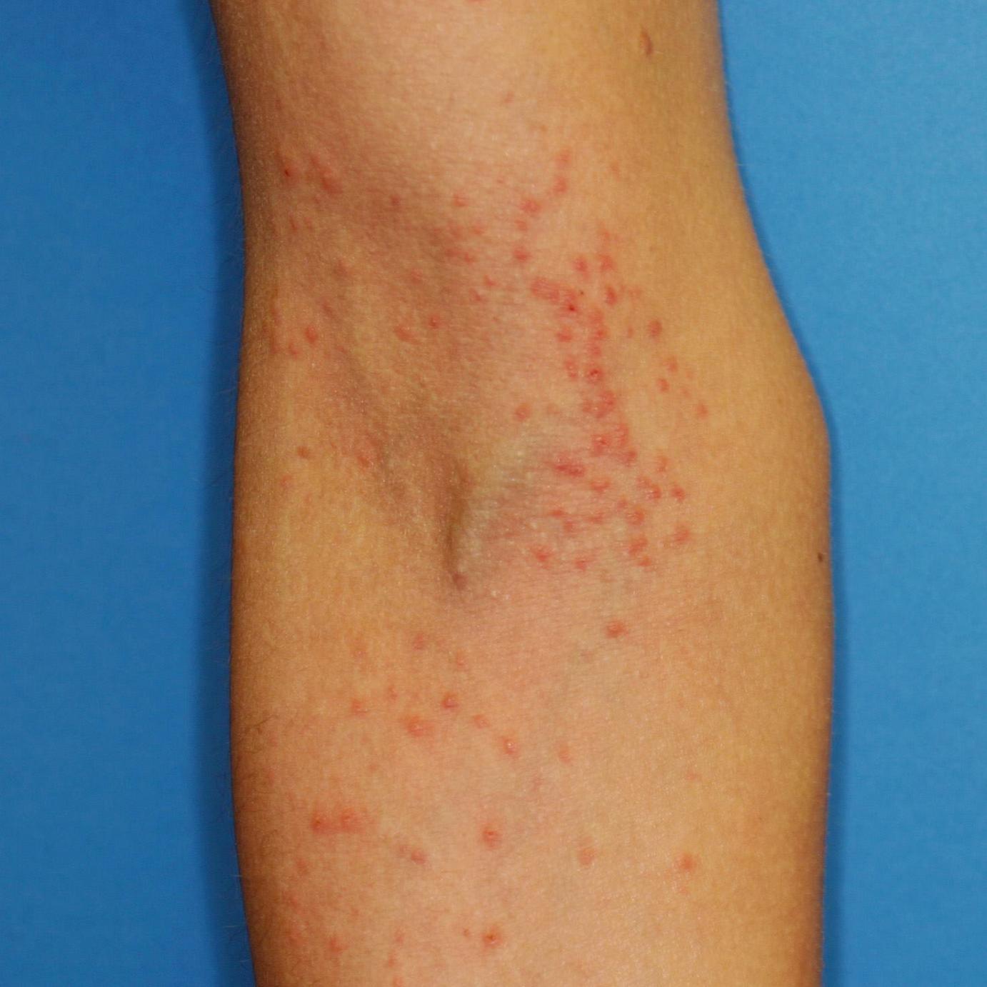Slide show: Common skin rashes - Mayo Clinic