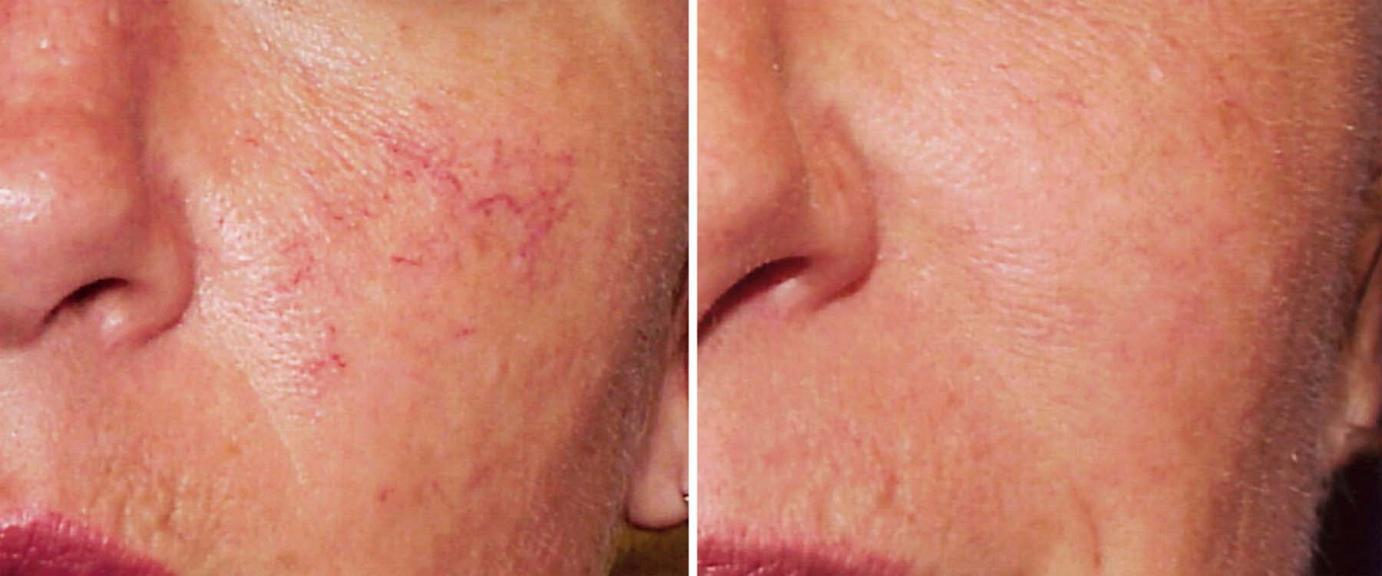 rosacea treatment before and after