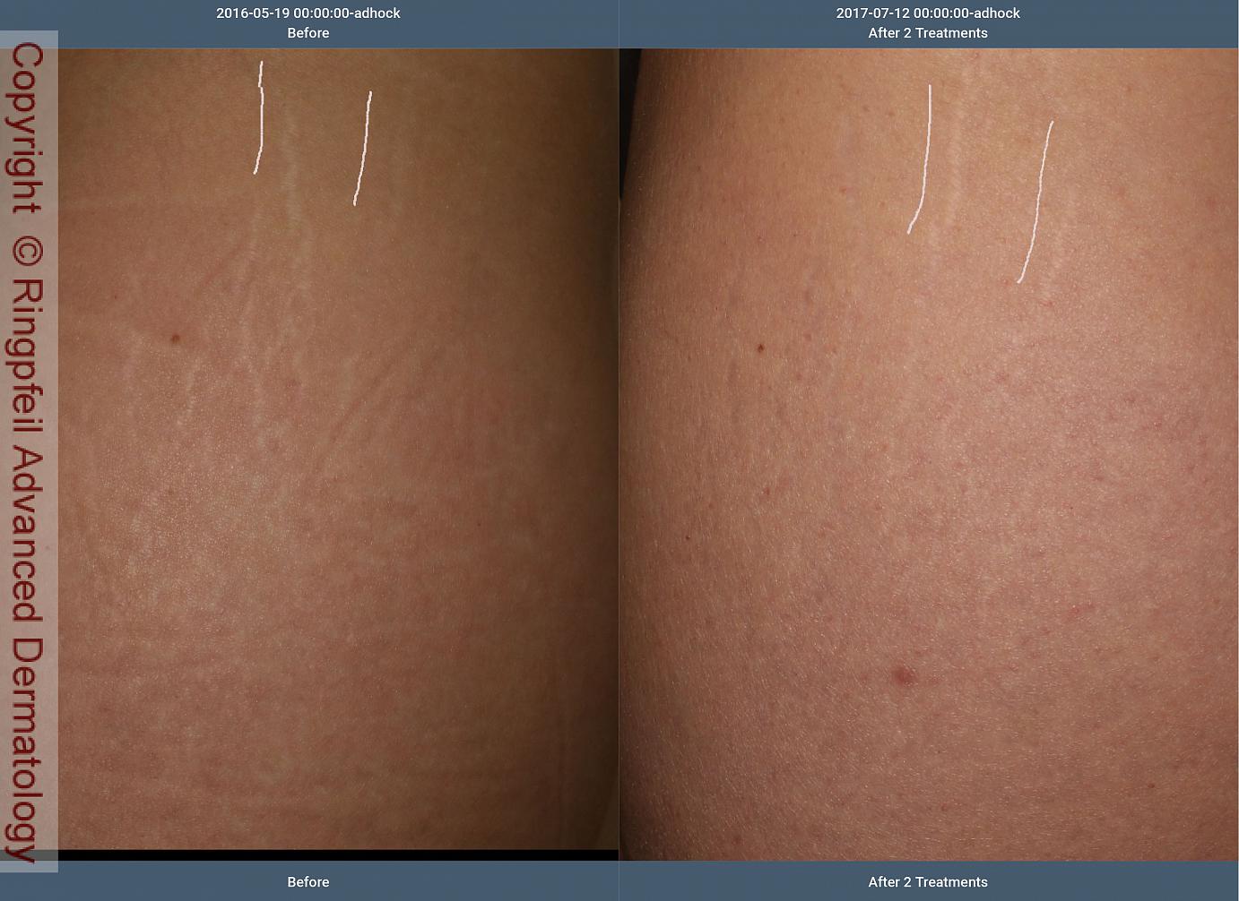 Stretch mark removal: Treatments and home remedies