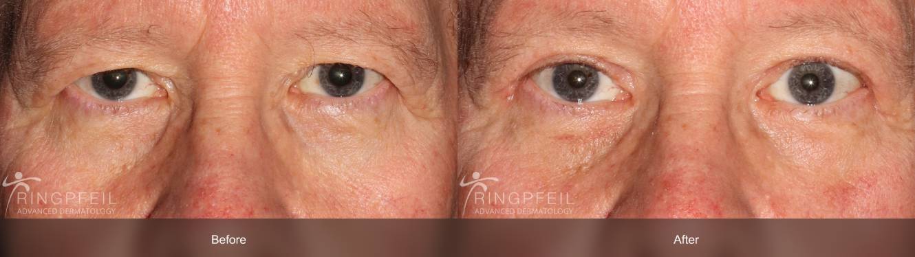 botox before and after