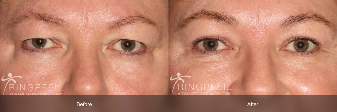 botox before and after