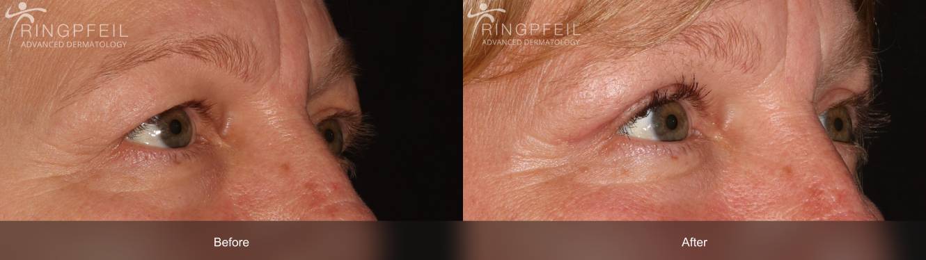Upper Blepharoplasty Procedure