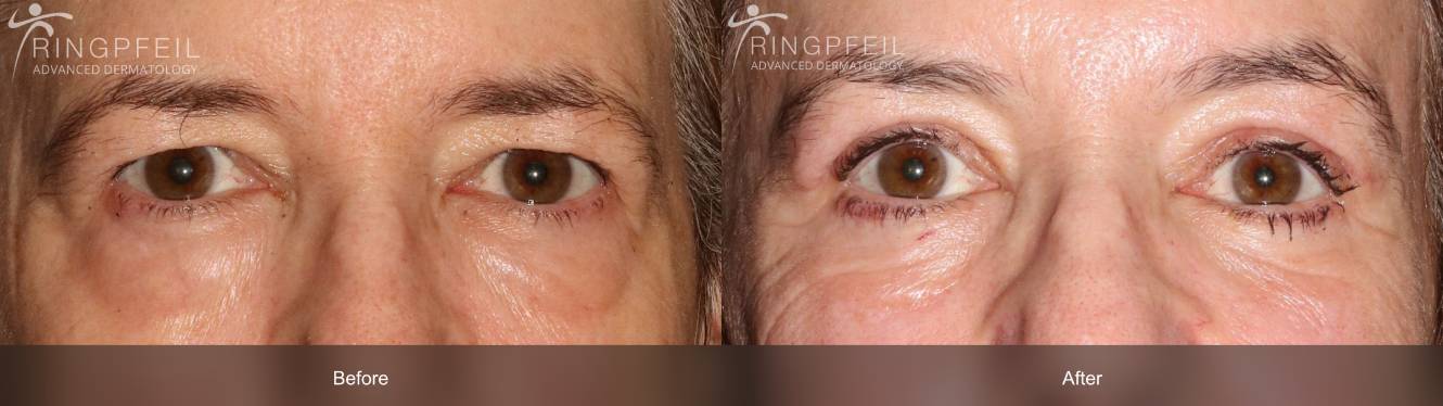 Upper Blepharoplasty Procedure