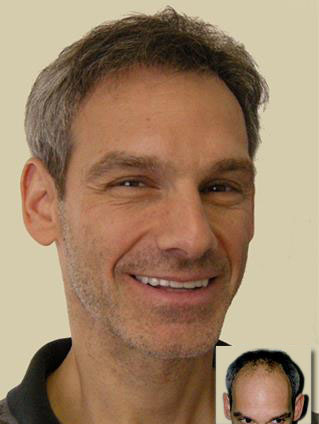 Hair Restoration With Dr. Milchak