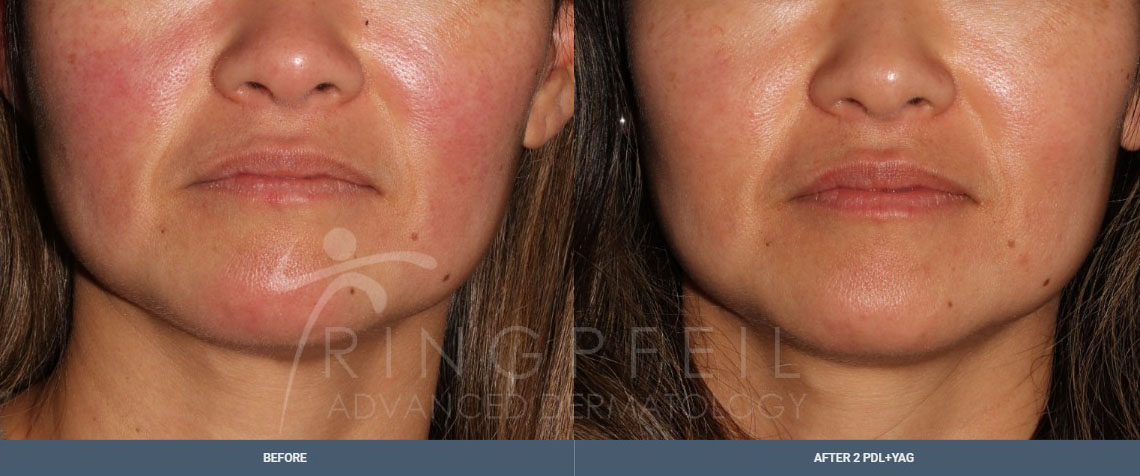 before and after Rosacea Treatment