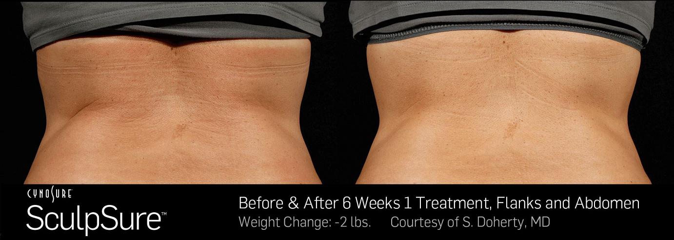 sculpsure before and after in Philadelphia