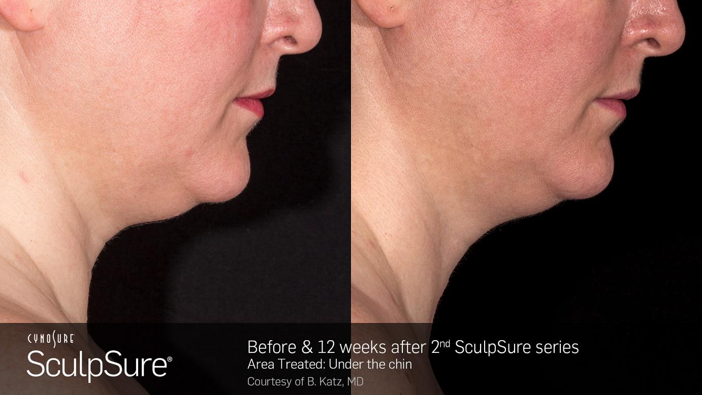 sculpsure before and after in Philadelphia