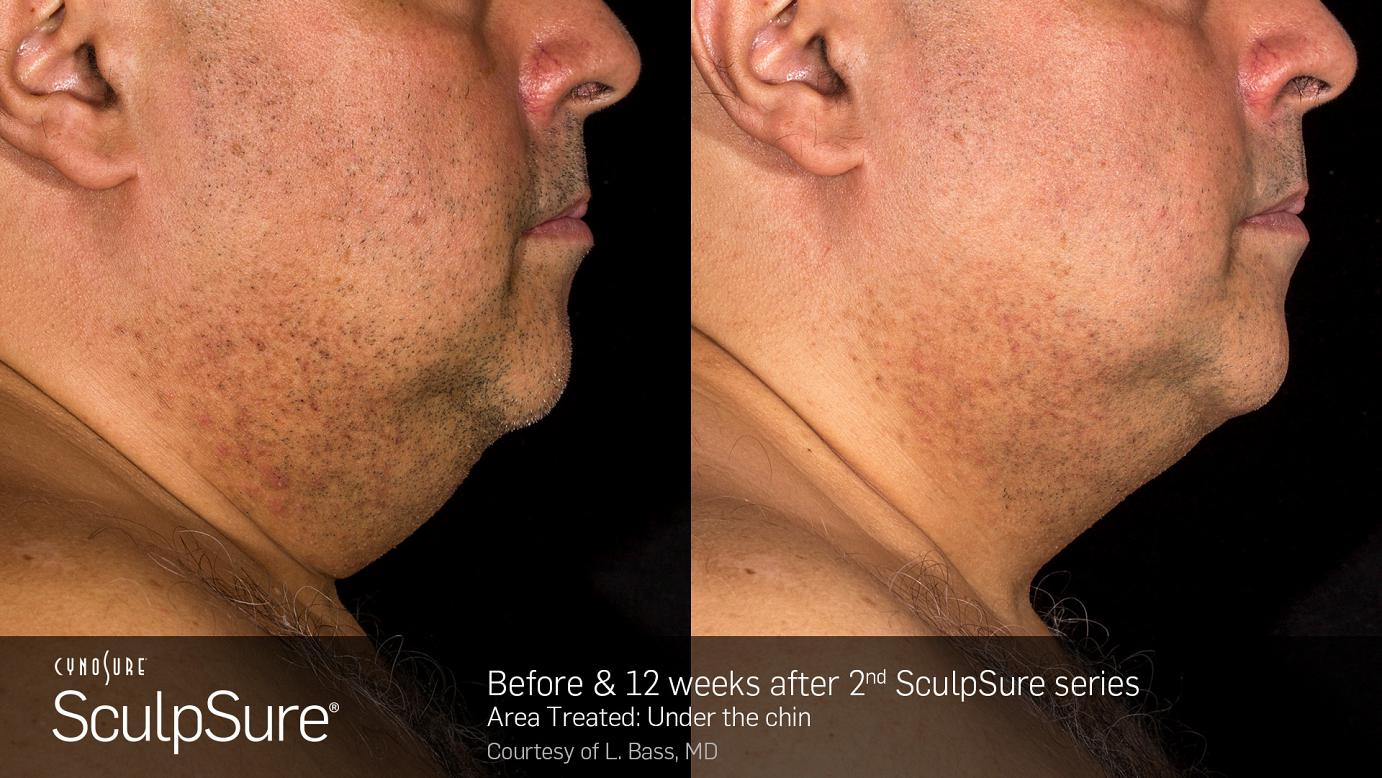 sculpsure before and after in Philadelphia