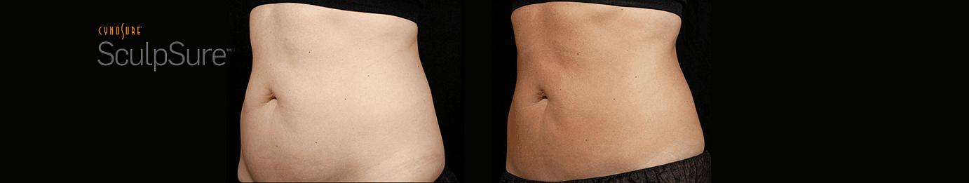 sculpsure before and after in Philadelphia