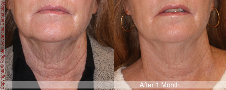 Neck Lifts Before and After left