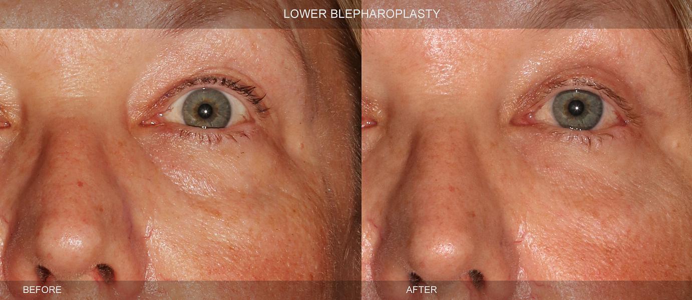 Upper Blepharoplasty Procedure