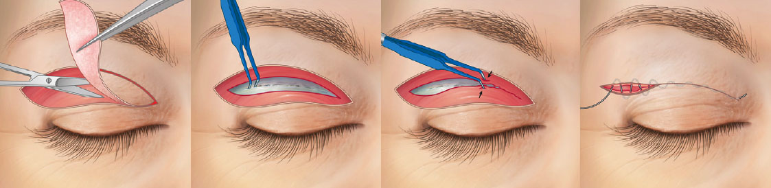 Blepharoplasty Procedure