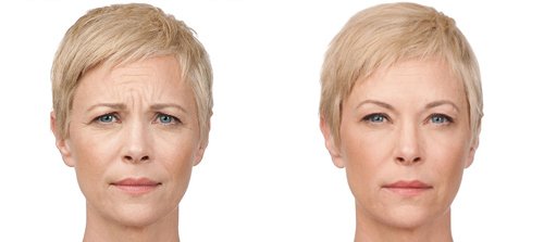 Botox vs fillers in Philadelphia 