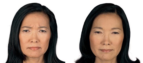 Botox vs fillers in Philadelphia 