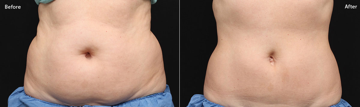 Coolsculpting NYC