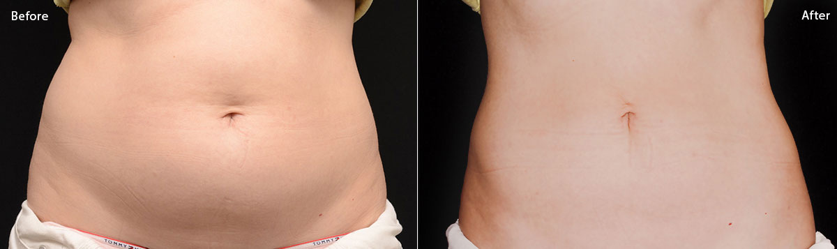CoolSculpting - Before & After Pictures