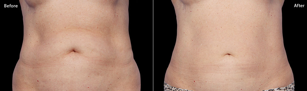 CoolSculpting - Before & After Pictures