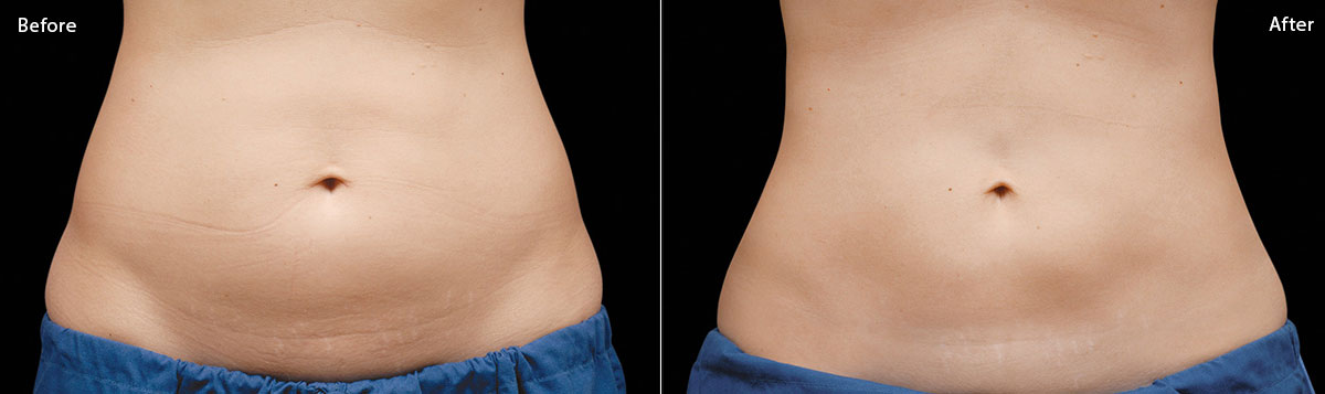 CoolSculpting - Before & After Pictures