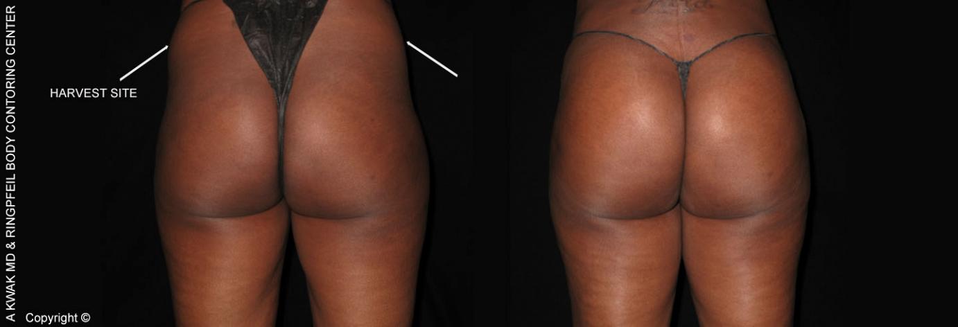 Buttocks Augmentation With Fat Transfer - Before & After