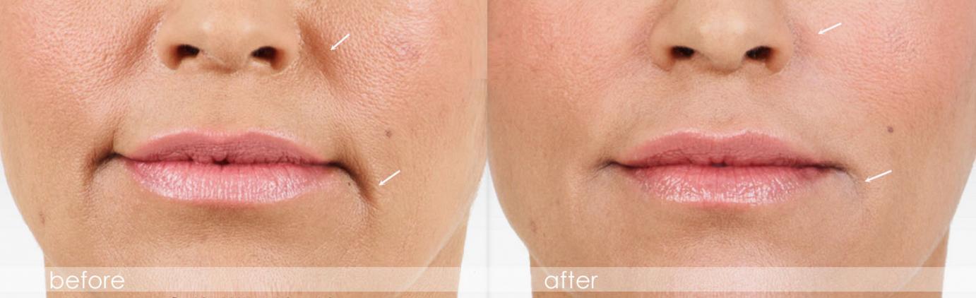 dermal filler - Juvederm - before and after