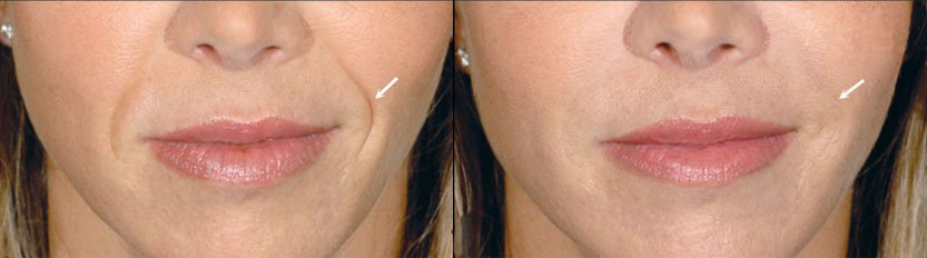 Restylane before and after