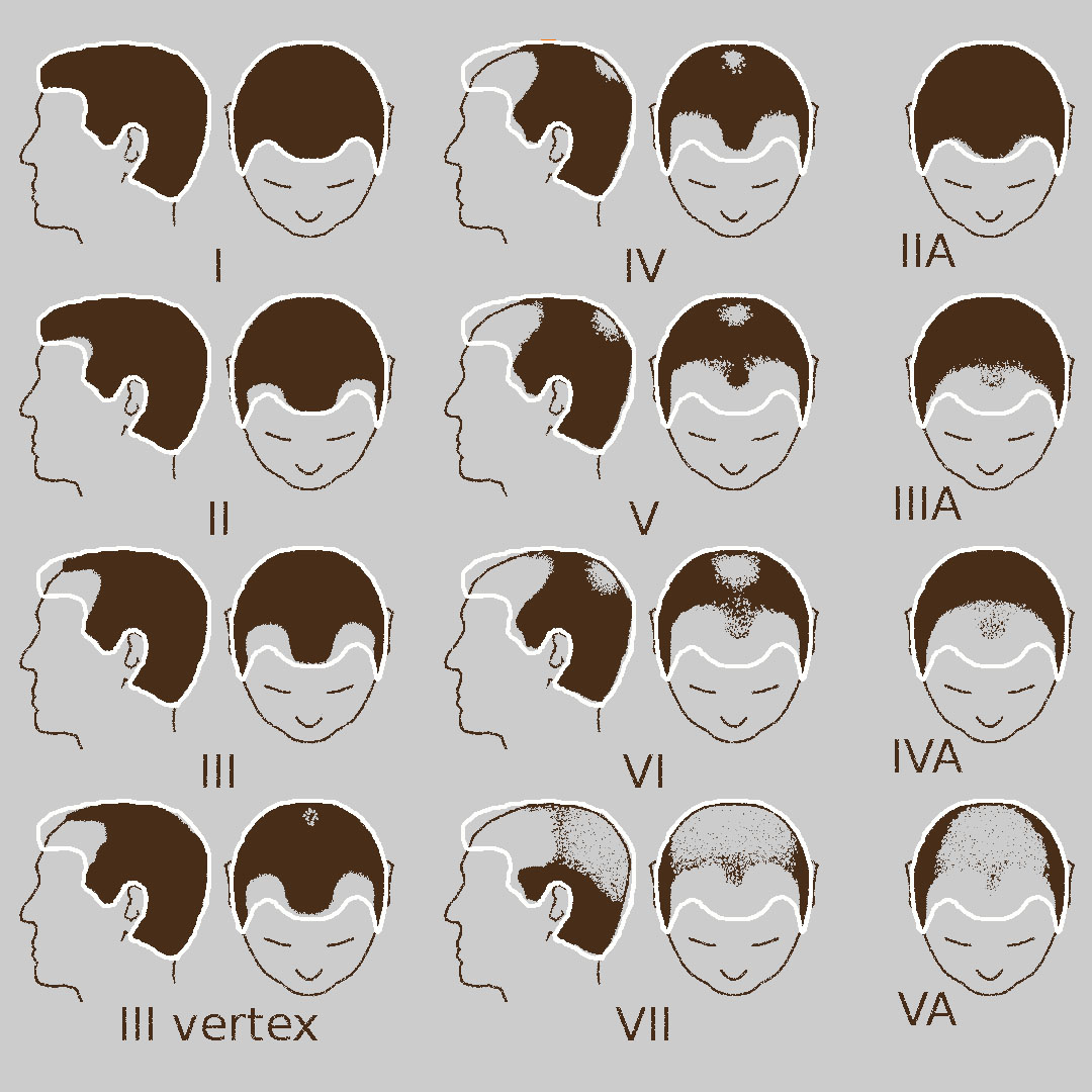 Male Baldness Pattern - Norwood Classification System