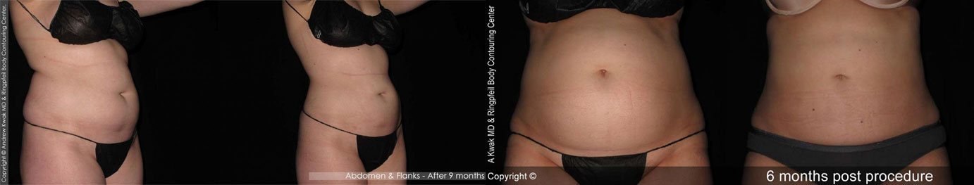 before and after liposuction abdomen flanks