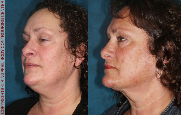 Neck Lifts Before and After left