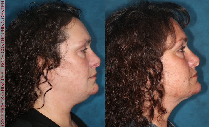 Neck Lifts Before and After right