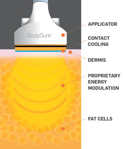 sculpsure before and after in Philadelphia