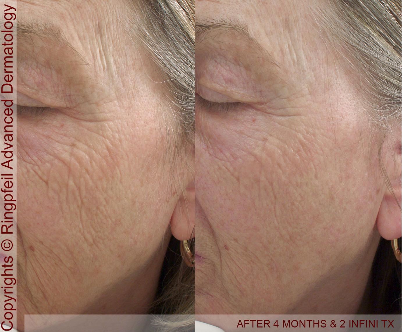 Skin Tightening Philadelphia Laser Surgery Main Line - Titan Laser