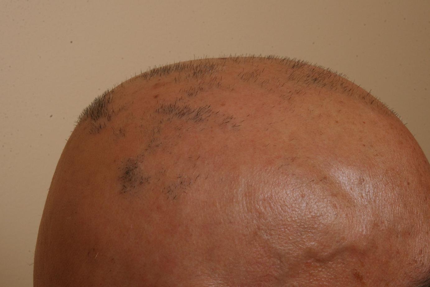 wide spread alopecia areata