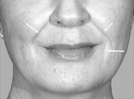 DERMAL FILLERS