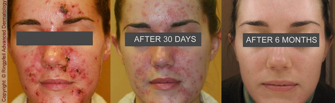 Acne Treatment Philadelphia &amp; Mainline PA