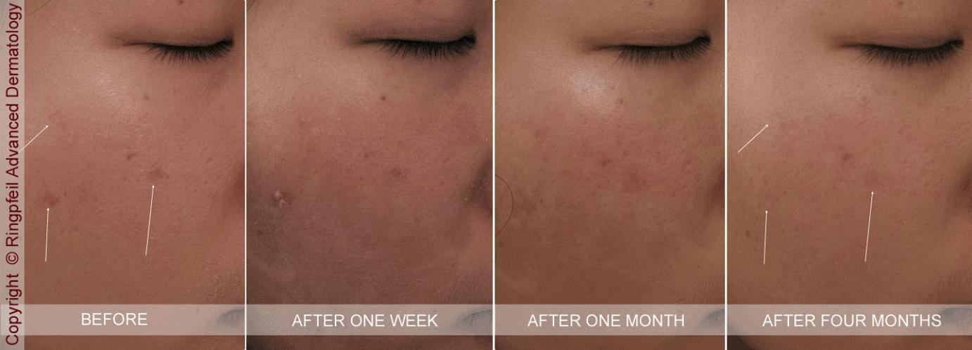 photos asian skin before and after treatment acne scar